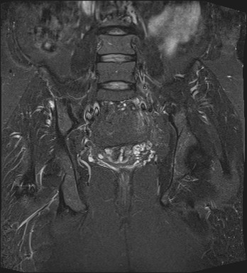 File:Adnexal multilocular cyst (O-RADS US 3- O-RADS MRI 3) (Radiopaedia 87426-103754 Coronal T2 fat sat 21).jpg