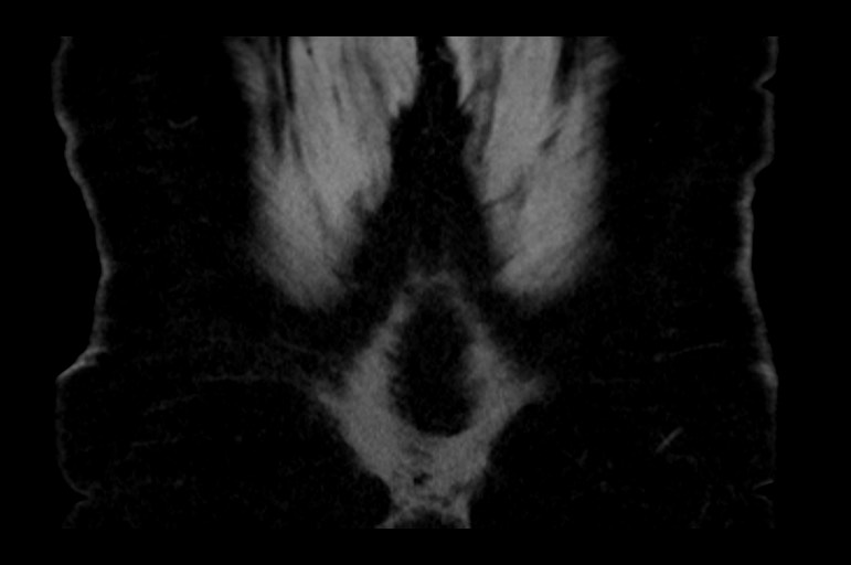 Adrenal cortical carcinoma (Radiopaedia 64017-72769 Coronal non-contrast 56).jpg