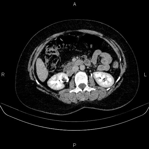 Adrenal cortical carcinoma (Radiopaedia 84882-100379 Axial C+ delayed 39).jpg