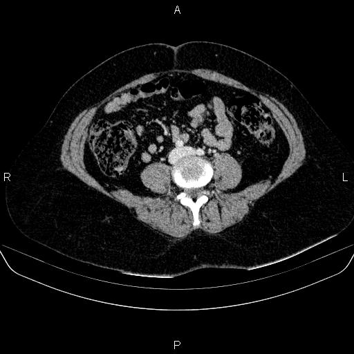 Adrenal cortical carcinoma (Radiopaedia 84882-100379 Axial C+ portal venous phase 57).jpg
