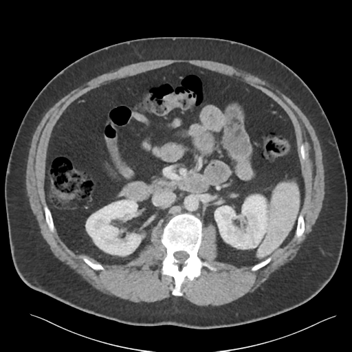 Adrenal cyst (Radiopaedia 45625-49777 Axial C+ portal venous phase 44).png