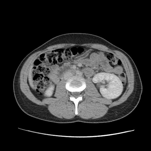 Adrenal cyst (Radiopaedia 64869-73813 Axial C+ portal venous phase 38).jpg
