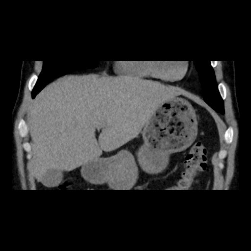 Adrenal gland trauma (Radiopaedia 81351-95079 Coronal non-contrast 26).jpg