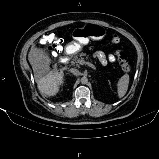 Adrenal hemorrhage (Radiopaedia 62622-70916 Axial non-contrast 67).jpg