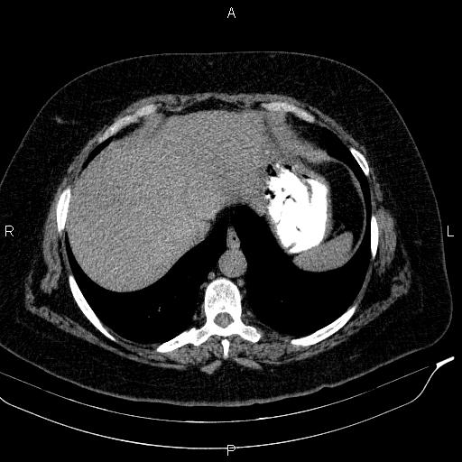 File:Adrenal myelolipoma (Radiopaedia 84319-99617 Axial With oral contrast 30).jpg