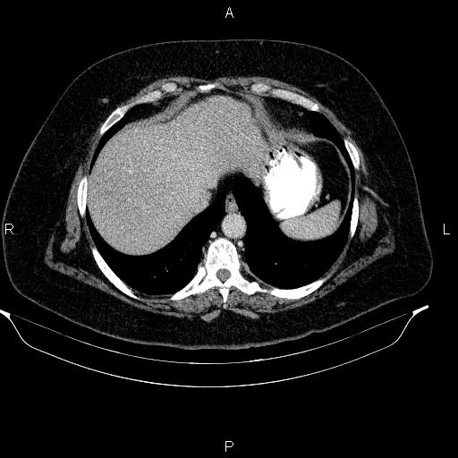 Adrenal myelolipoma (Radiopaedia 84319-99617 Axial renal cortical phase 18).jpg