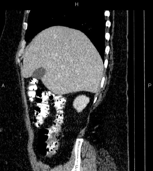 Adrenal myelolipoma (Radiopaedia 84319-99617 Sagittal renal cortical phase 19).jpg
