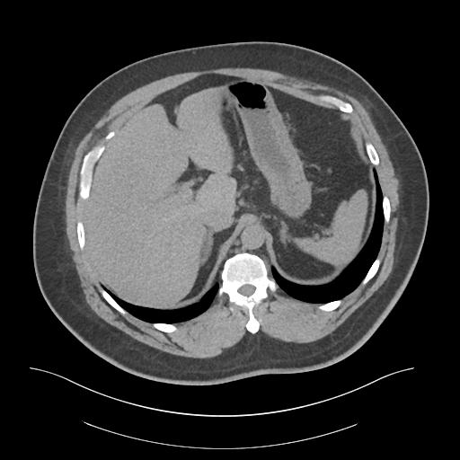 File:Adrenal vein sampling and adrenal nodular hyperplasia - Conn syndrome (Radiopaedia 30561-31337 Axial non-contrast 16).jpg
