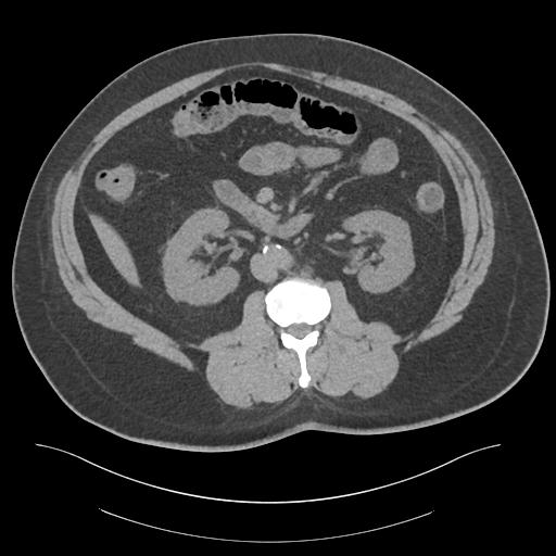 File:Adrenal vein sampling and adrenal nodular hyperplasia - Conn syndrome (Radiopaedia 30561-31337 Axial non-contrast 43).jpg