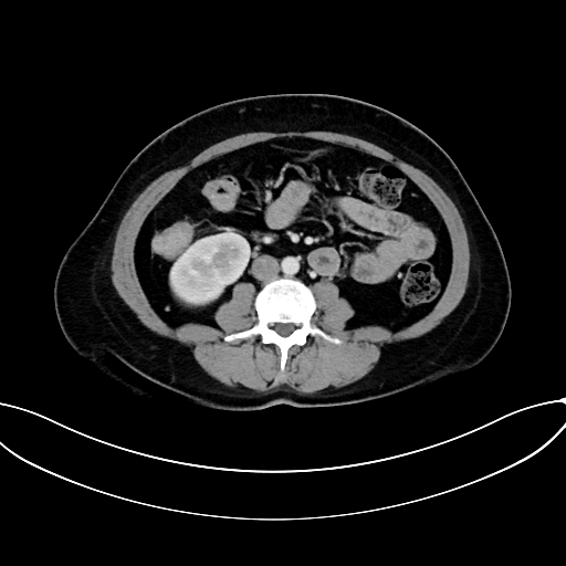 Adrenocortical carcinoma (Radiopaedia 87281-103569 Axial C+ portal venous phase 47).jpg