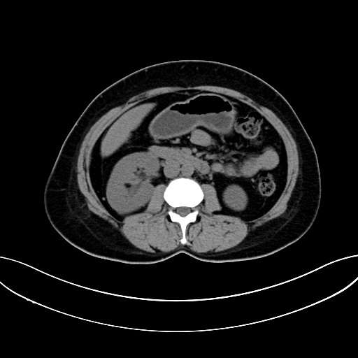 Adrenocortical carcinoma (Radiopaedia 87281-103569 Axial non-contrast 42).jpg
