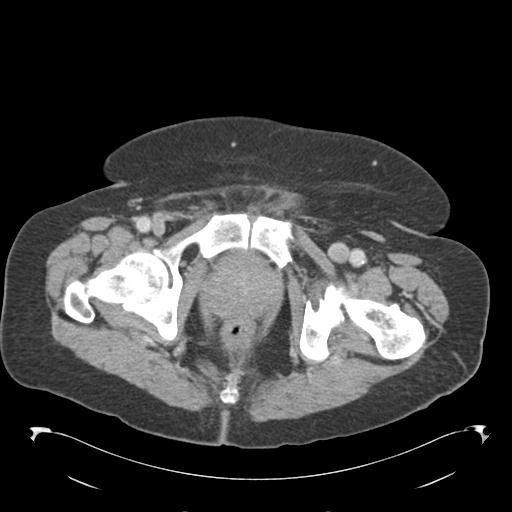 Adult ileal intussusception with secondary obstruction (Radiopaedia 30395-31051 Axial C+ portal venous phase 77).jpg