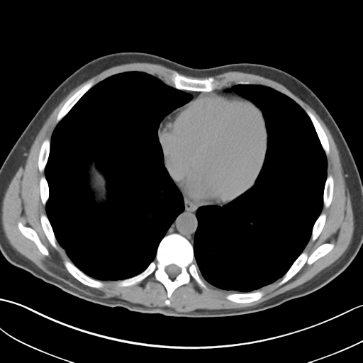 File:Adult polycystic kidney disease (Radiopaedia 47866-52626 Axial non-contrast 2).png