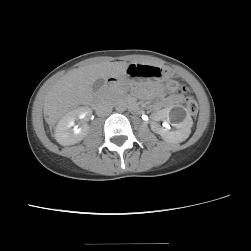Adult polycystic kidney disease (Radiopaedia 48845-53876 Axial renal excretory phase 45).jpg