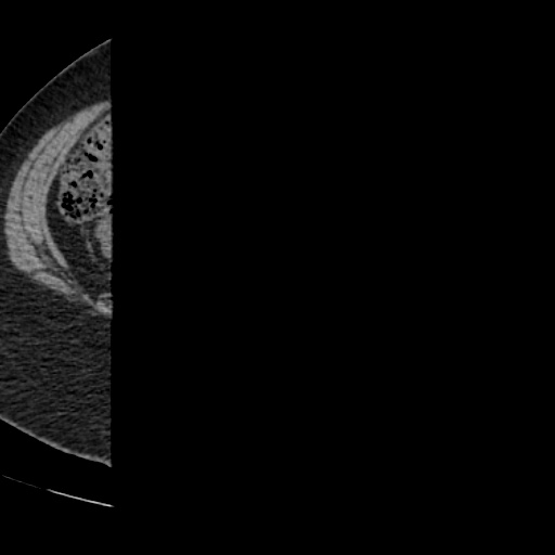 Adult polycystic kidney disease (Radiopaedia 59075-66368 Axial non-contrast 58).jpg
