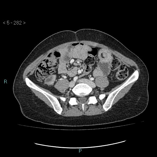 File:Adult transient intestinal intussusception (Radiopaedia 34853-36310 Axial C+ portal venous phase 63).jpg