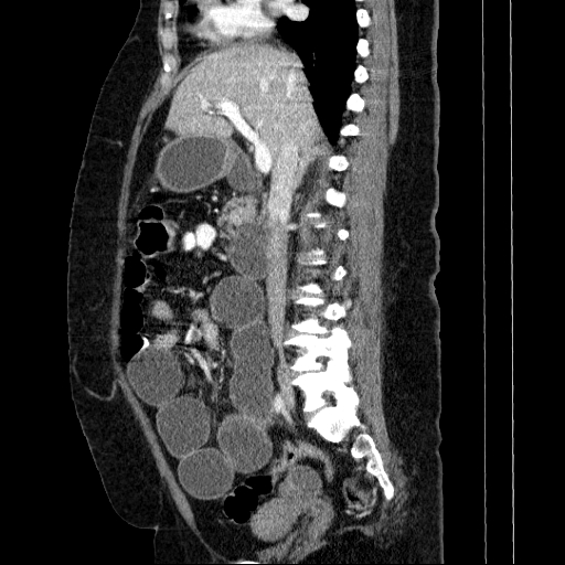 Afferent loop syndrome - secondary to incarcerated trocar site hernia (Radiopaedia 82959-97305 Sagittal C+ portal venous phase 90).jpg