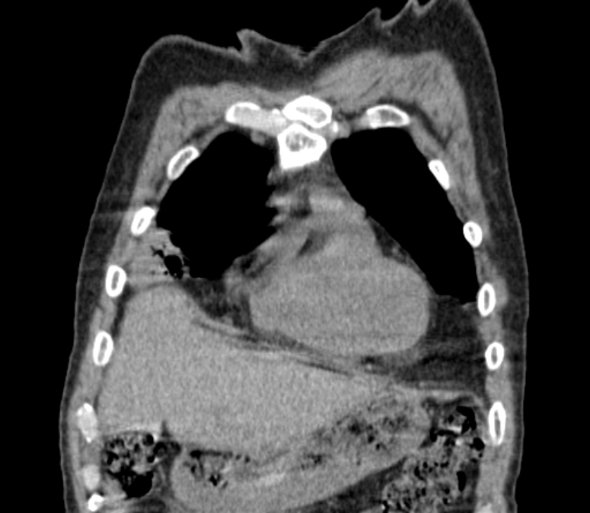 Airway foreign body in adult (Radiopaedia 85907-101779 Coronal liver window 42).jpg