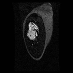 Alveolar soft part sarcoma (Radiopaedia 64501-73678 D 123).jpg