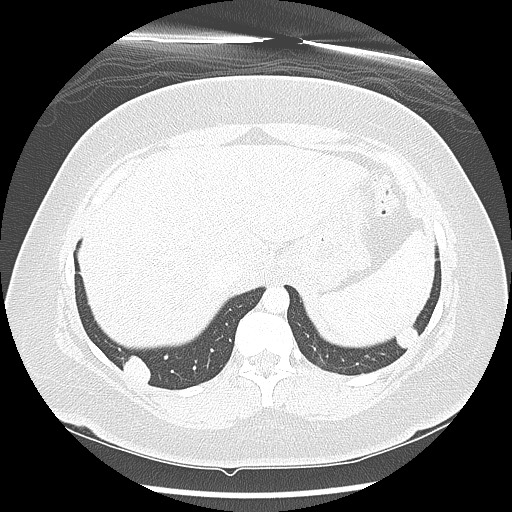 Alveolar soft part sarcoma - right leg (Radiopaedia 59432-67091 Axial lung window 100).jpg