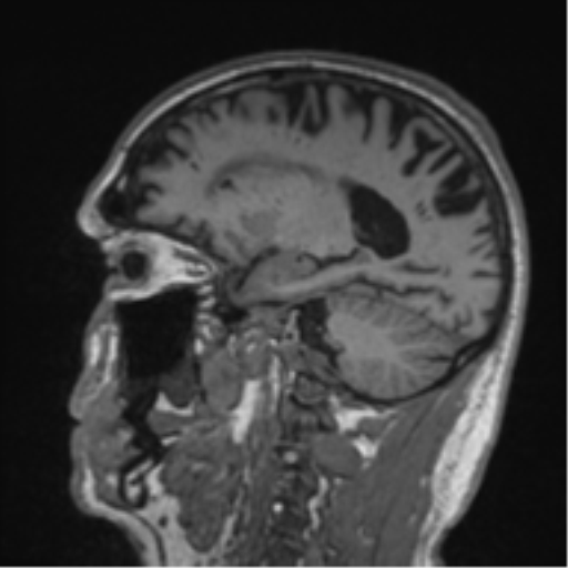 File:Alzheimer's disease- with Gerstmann syndrome and dressing apraxia (Radiopaedia 54882-61150 Sagittal T1 47).png