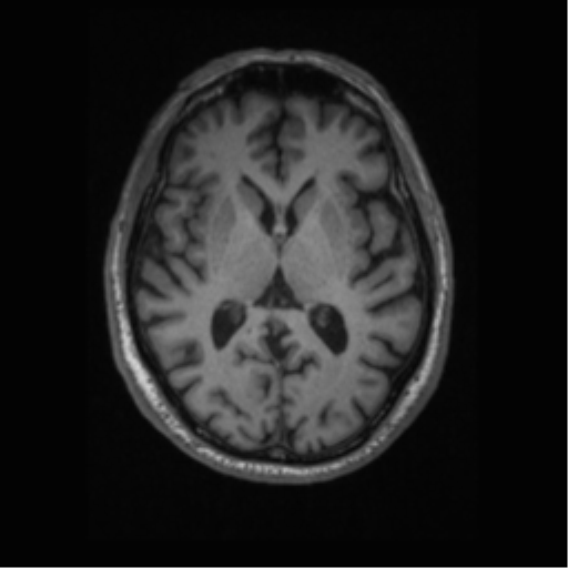 Alzheimer disease - probable (Radiopaedia 35334-36837 Axial T1 41).png