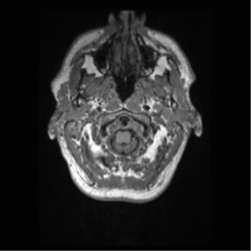 File:Alzheimer disease - probable (Radiopaedia 35334-36837 Axial T1 8).png