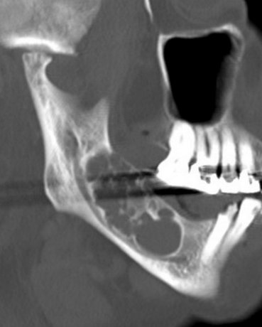 File:Ameloblastoma (Radiopaedia 2577-6272 Oblique bone window 1).jpg
