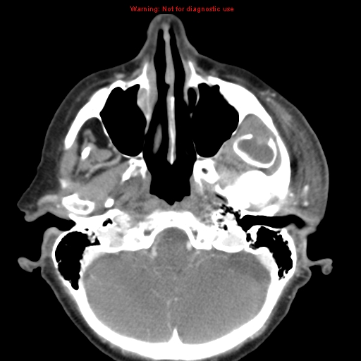 Ameloblastoma (Radiopaedia 27437-27631 A 12).jpg