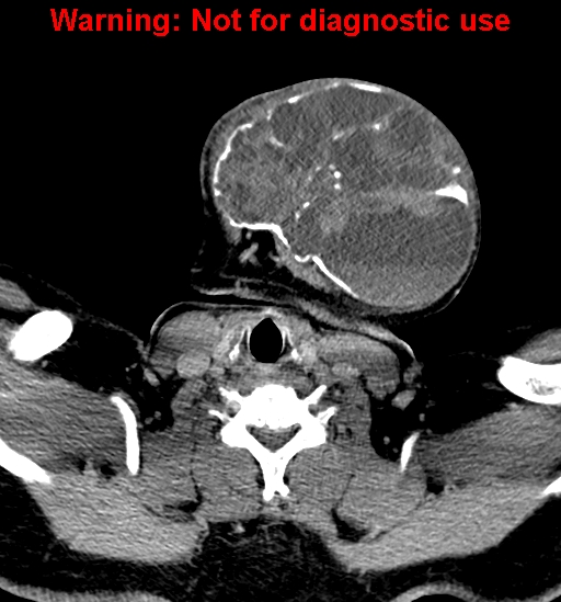 File:Ameloblastoma (Radiopaedia 33126-34164 B 28).jpg