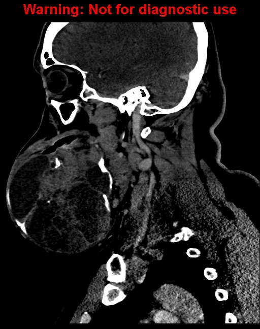 Ameloblastoma (Radiopaedia 33126-34164 F 25).jpg