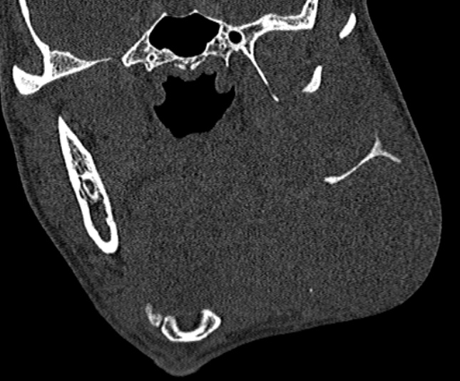 Ameloblastoma (Radiopaedia 51921-57766 Coronal bone window 143).jpg