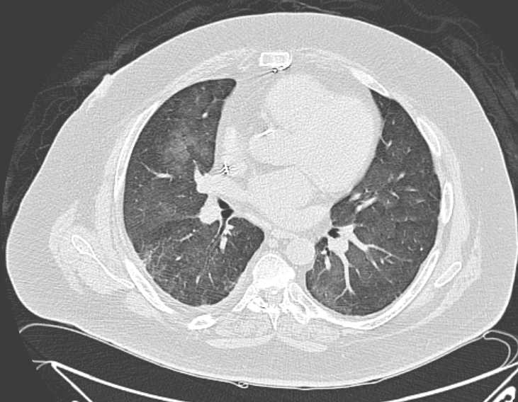 Amiodarone lung (Radiopaedia 62514-70769 Axial lung window 47).jpg