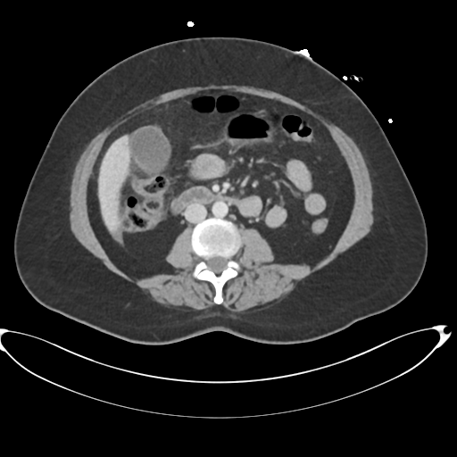 File:Amoebic liver abscess (Radiopaedia 52611-58530 A 53).png
