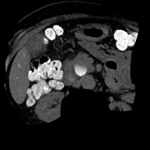 Ampullary adenocarcinoma (Radiopaedia 34013-35241 AXIAL MIPS 3-1.5 69).png
