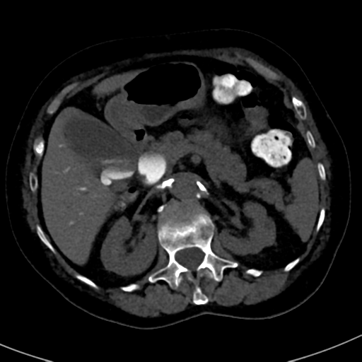 File:Ampullary adenocarcinoma (Radiopaedia 34013-35241 AXIAL THICK 30).png