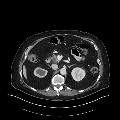 File:Ampullary adenocarcinoma (Radiopaedia 59373-66734 Axial 116).jpg