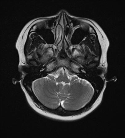 File:Anaplastic astroblastoma (Radiopaedia 55666-62194 Axial T2 6).png