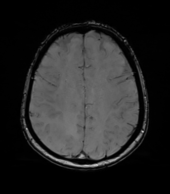 Anaplastic astrocytoma (Radiopaedia 86943-103160 Axial SWI 62).png