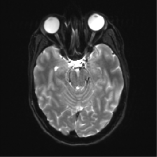 Anaplastic astrocytoma IDH mutant (Radiopaedia 50046-55341 Axial DWI 10).png