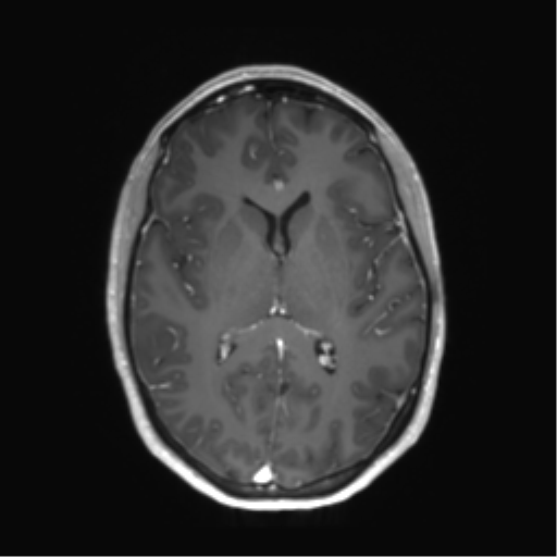 File:Anaplastic astrocytoma IDH mutant (Radiopaedia 50046-55341 Axial T1 C+ 27).png
