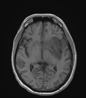 Anaplastic astrocytoma IDH wild-type (Radiopaedia 49984-55273 Axial T1 28).png