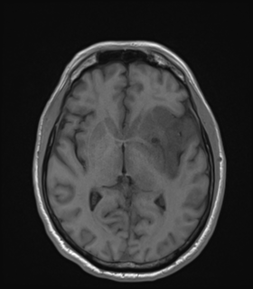 Anaplastic astrocytoma IDH wild-type (Radiopaedia 49984-55273 Axial T1 29).png