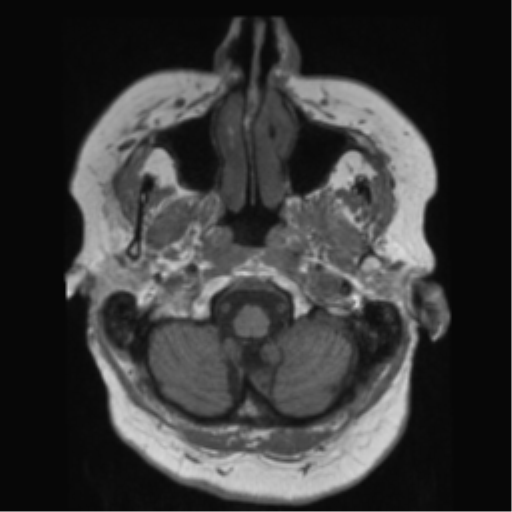 File:Anaplastic astrocytoma IDH wild-type (pseudoprogression) (Radiopaedia 42209-45278 Axial T1 27).png
