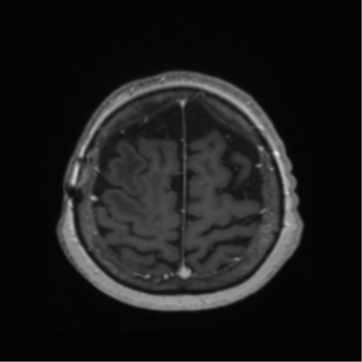 File:Anaplastic astrocytoma IDH wild-type (pseudoprogression) (Radiopaedia 42209-45278 Axial T1 C+ 127).png