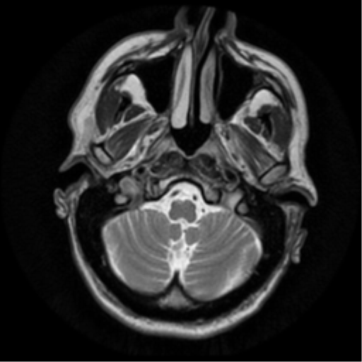 File:Anaplastic meningioma with recurrence (Radiopaedia 34452-35790 Axial T2 4).png