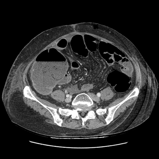 Anastomosis leak at ileostomy closure site (Radiopaedia 82138-96184 B 155).jpg
