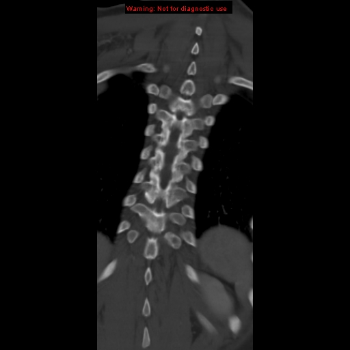 File:Aneurysmal bone cyst (Radiopaedia 9419-10102 Coronal bone window 18).jpg