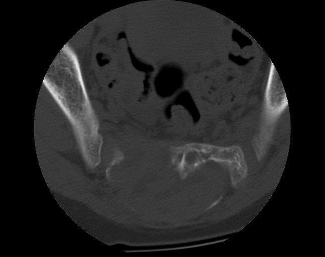 Aneurysmal bone cyst - sacrum (Radiopaedia 65190-74195 Axial bone window 31).jpg