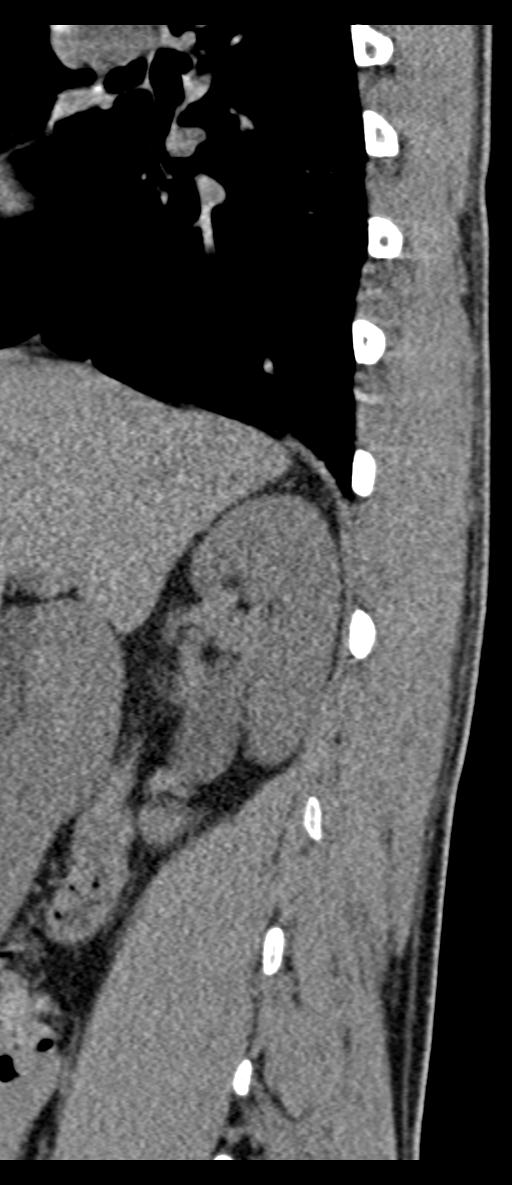 Aneurysmal bone cyst T11 (Radiopaedia 29294-29721 E 69).jpg